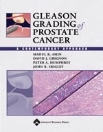 Gleason Gradin Of Prostate Cancer