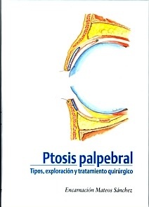 Ptosis Palpebral "Tipos, Exploración y Tratamiento Quirúrgico"