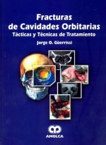 Fracturas de Cavidades Orbitarias "Tácticas y Técnicas de Tratamiento"