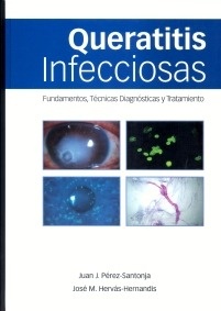 Queratitis infecciosas "Fundamentos, técnicas diagnósticas y tratamiento"