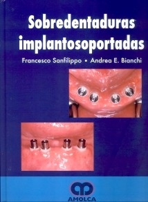 Sobredentaduras Implantosoportadas