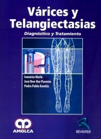 Várices y Telangiectasias "Diagnóstico y Tratamiento"