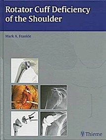 Rotator Cuff Deficiency Of The Shoulder
