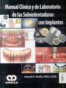 Manual Clínico y de Laboratorio de las Sobredentaduras con Implantes