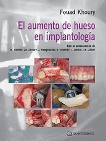 El Aumento de Hueso en la Implantología Oral