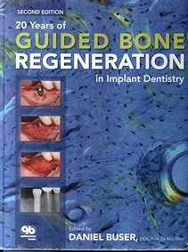20 Years Of Guided Bone Regeneration In Implant Dentistry