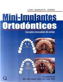 Mini Implantes Ortodónticos "Conceptos Innovadores del Anclaje"