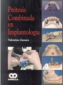 Prótesis Combinada en Implantología