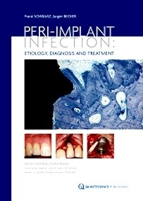 Peri-Implant Infection: Etiology, Diagnosis and Treatment