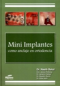 Mini Implantes Como Anclaje en Ortodoncia