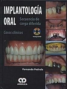 Implantologia Oral. Secuencia de Carga Diferida. Casos Clinicos + Dvd