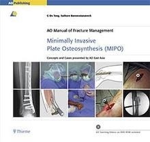 AO Manual of Fracture Management Minimally Invasive Plate Osteosynthesis (MIPO)