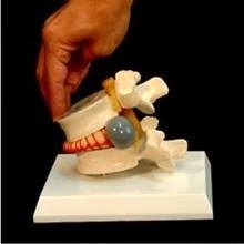 Simulador de Vértebra con Hernia Discal Posterolatera
