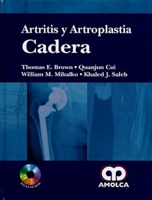 Artritis y Artroplastia. Cadera