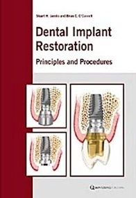 Dental Implant Restoration "Principles And Procedures"