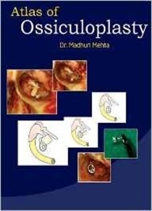 Atlas Of Ossiculoplasty