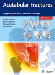 Acetabular Fractures "Diagnosis, Indications, Treatment Strategies"