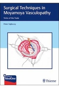 Surgical Techniques In Moyamoya Vasculopathy "Trick Of The Trade"