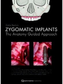 Zygomatic Implants "The Anatomy Guided Approach"