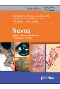 Nevos. Nevos  Tumores Neviformes y Síndromes Névicos