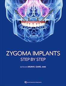 Zygoma Implants "Step by Step"