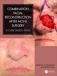 Combination Facial Reconstruction After Mohs Surgery "A Case Based Atlas"