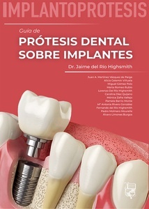 Implantoprótesis. Guía de Prótesis Dental sobre Implantes