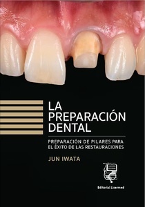 La Preparación Dental "Preparación de Pilares para el Éxito de las Restauraciones"