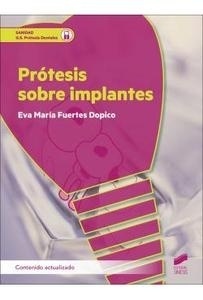 Prótesis sobre Implantes