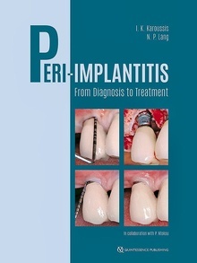 Peri-Implantitis From Diagnosis To Treatment